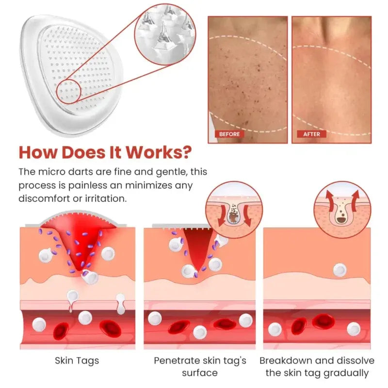 Derma Smooth Skin Tag Removal Patches ❤️🩹 | Secret to Spotless Skin ✨