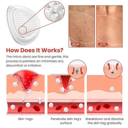 Derma Smooth Skin Tag Removal Patches ❤️🩹 | Secret to Spotless Skin ✨